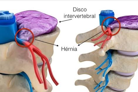 Hérnia de disco: entenda o problema, causas e tratamentos